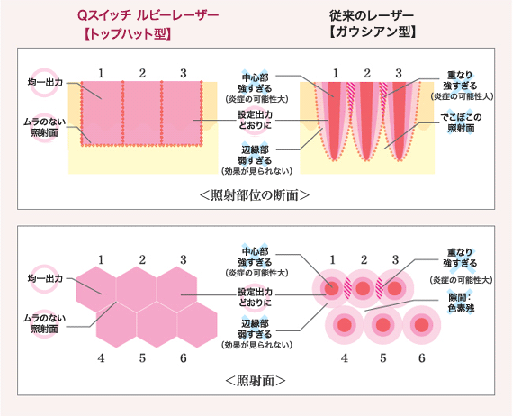 Qスイッチ ルビーレーザーと従来のレーザーとの違い（イラスト解説）