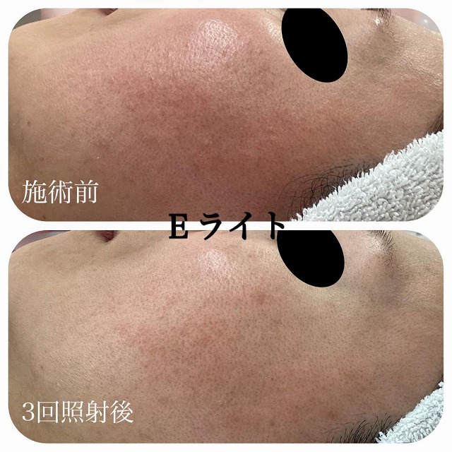 Eライト治療