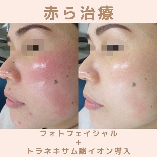 赤ら顔治療