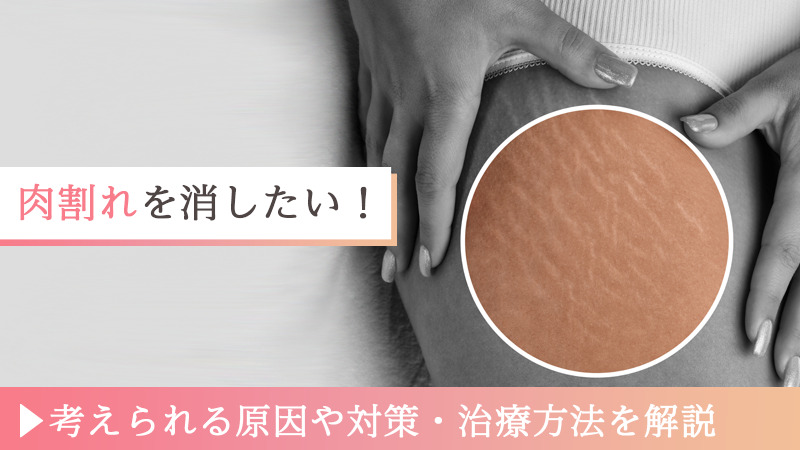 肉割れを消したい！考えられる原因や対策・治療方法を解説