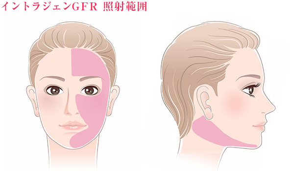 イントラジェンの照射範囲イラスト解説