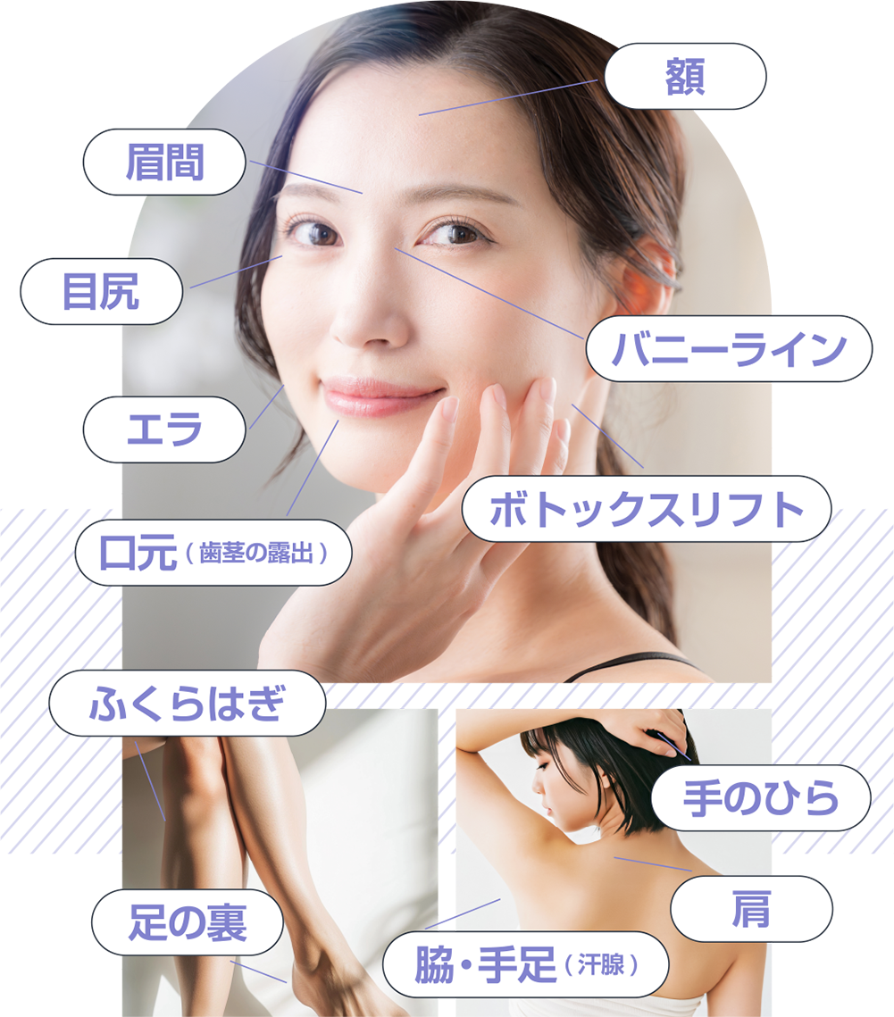 ボトックスの注入箇所