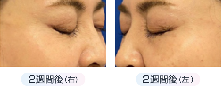 目尻のシワに