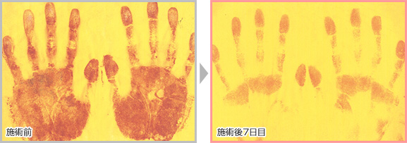 多汗症の術前術後
