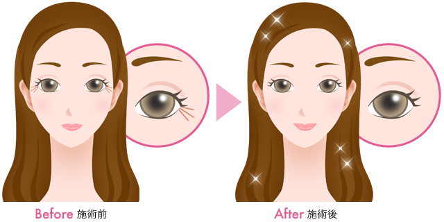 5分の治療でシワを消す(目尻)