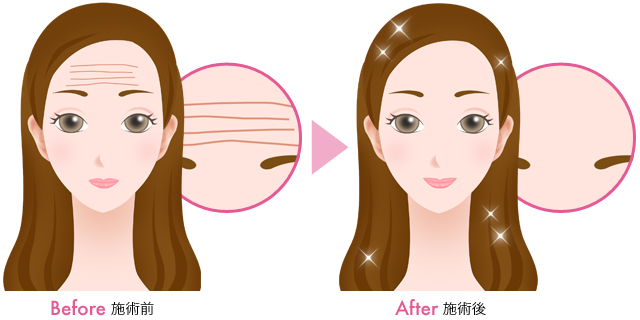 5分の治療でシワを消す(額)