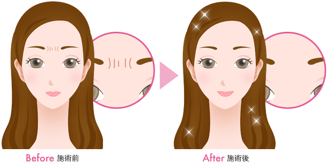 5分の治療でシワを消す(眉間)