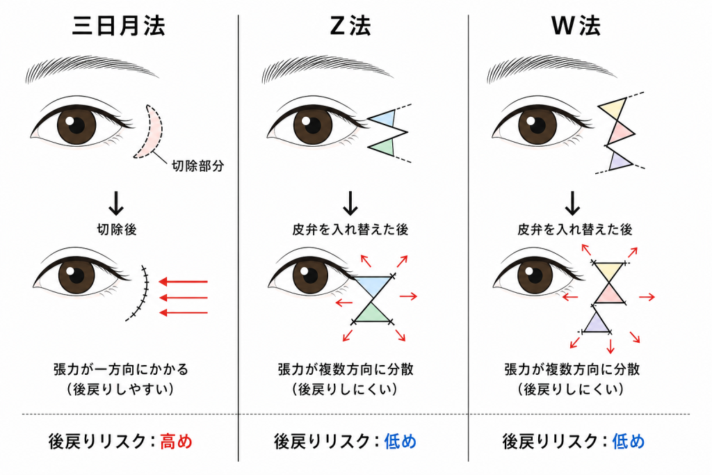 Z法・W法が後戻りしにくいとされる