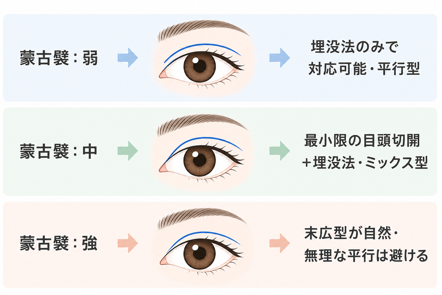 蒙古襞タイプ別に見る推奨される二重デザイン