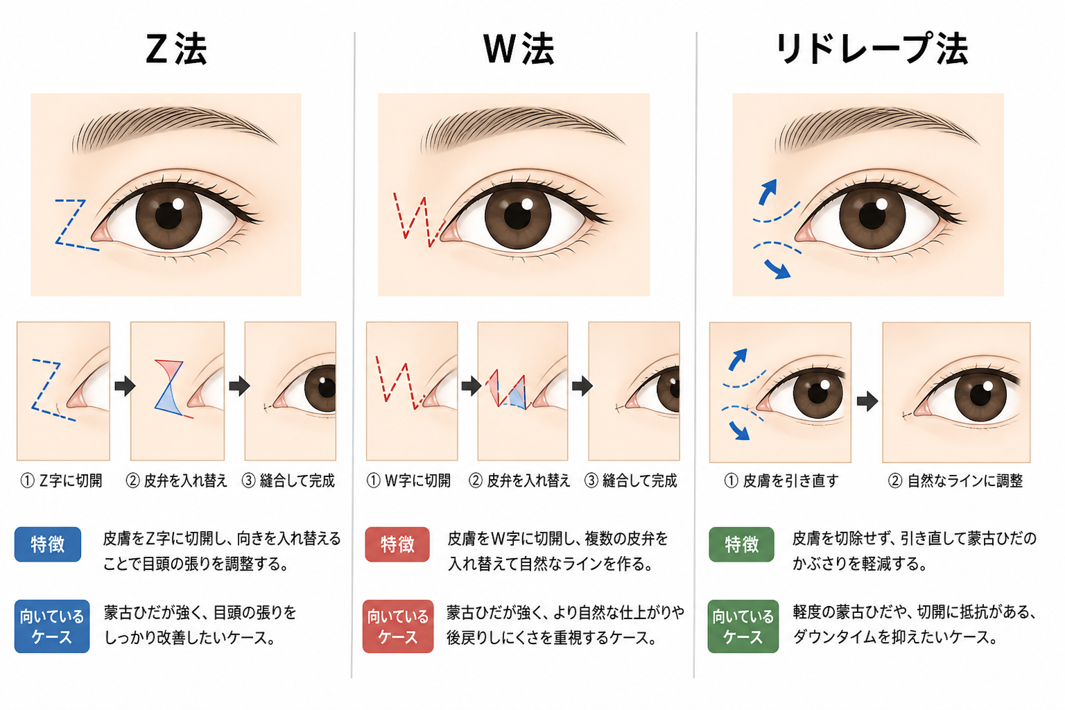 Z法・W法など代表的な術式の違い