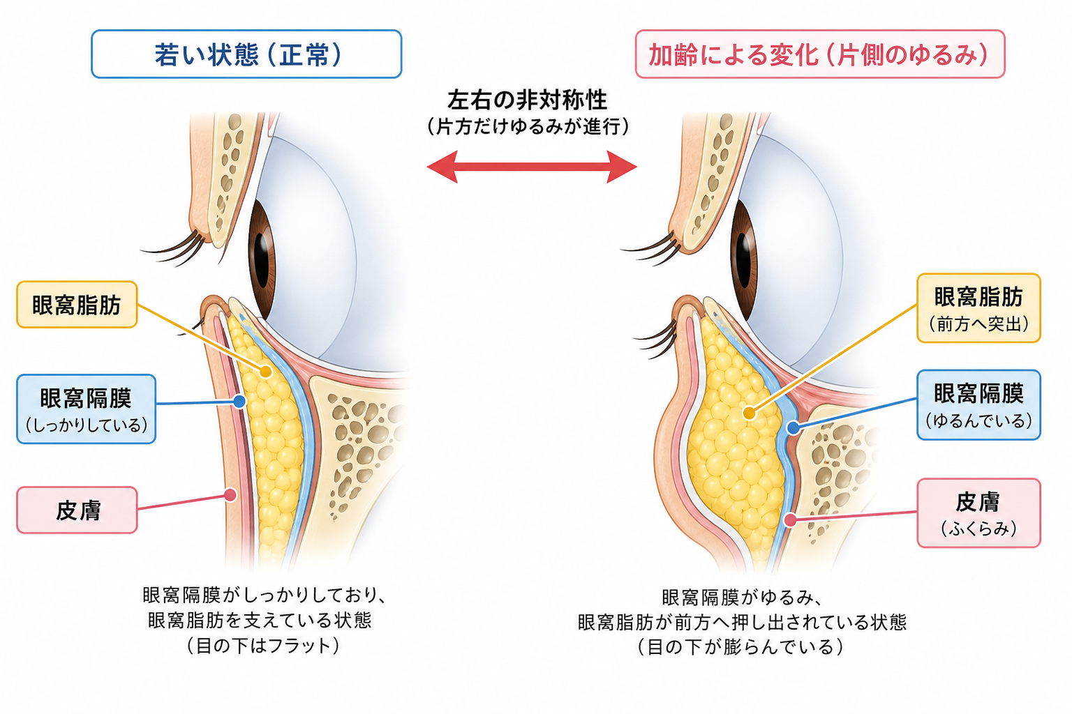 眼窩脂肪の左右差(生まれつき)