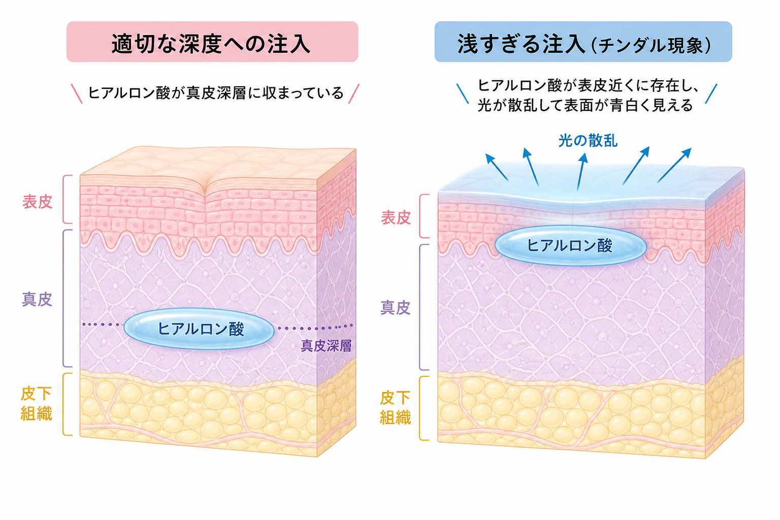 チンダル現象(青く透けて見える)とは