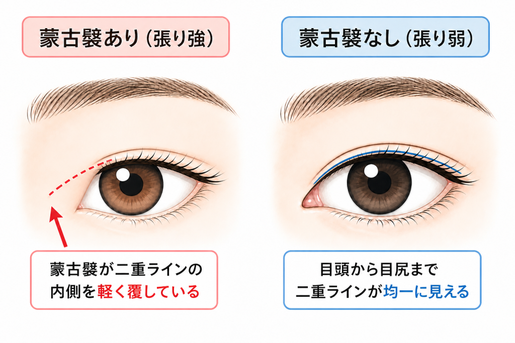 蒙古襞が平行二重を作りにくくする理由