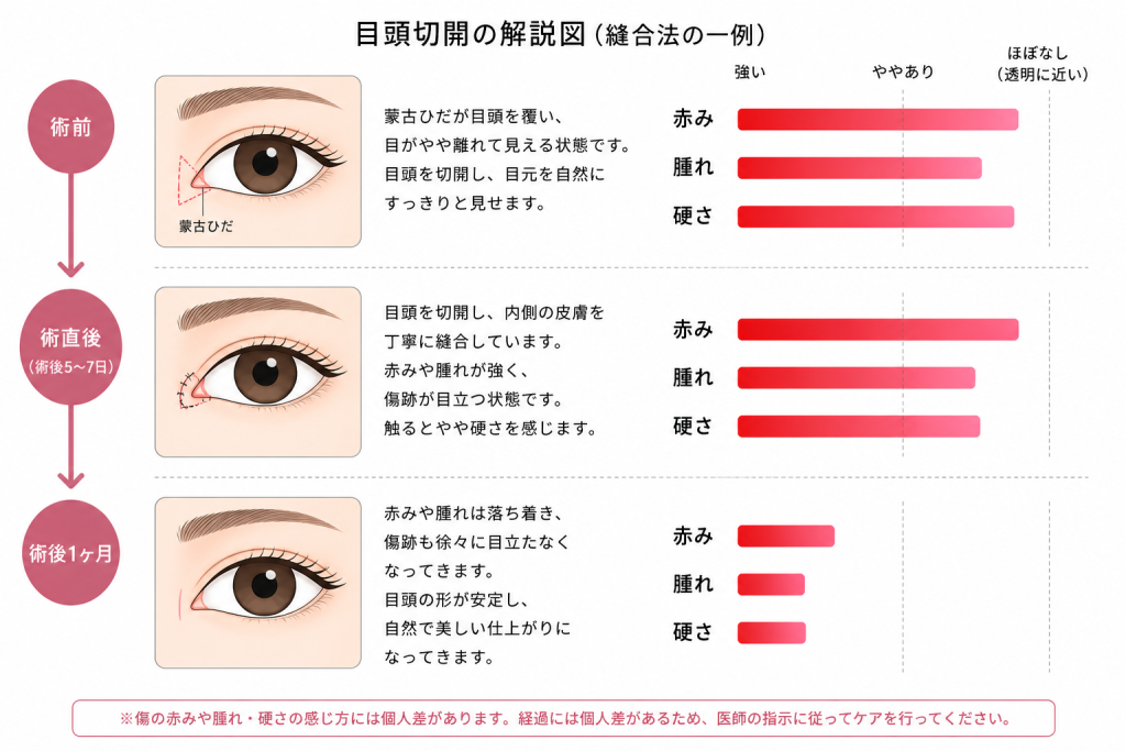 術後3ヶ月で仕上がりが落ち着くまで