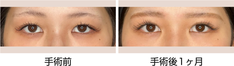 目尻にかけて広がるセミアウト二重