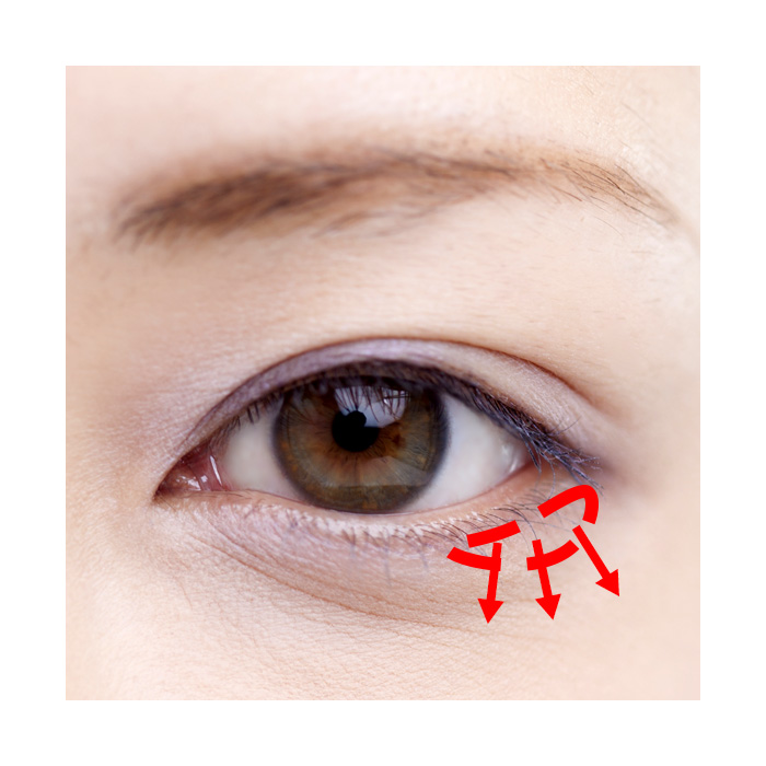 たれ目形成(下眼瞼下制)